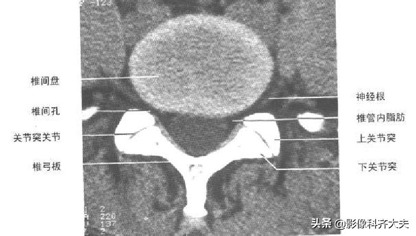 腰椎间盘突出最好的影像诊断方法,腰椎间盘突出的影像学检查