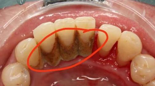 牙结石太顽固了怎么能把它抠掉,牙结石不管它会严重吗