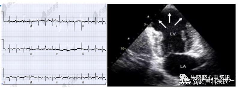 t波倒置9个真相图解,t波倒置判断口诀