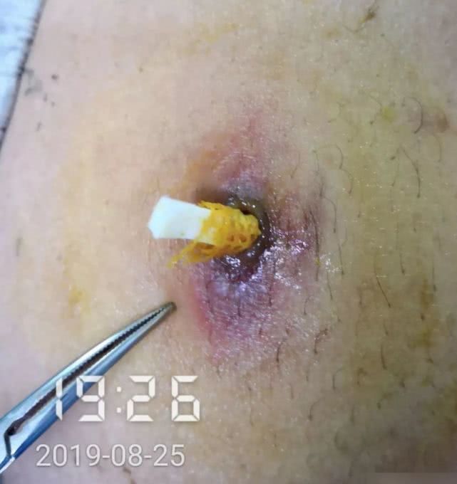 阑尾炎形成窦道的原因,阑尾炎一孔微创手术全过程