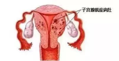 子宫腺肌瘤会成癌吗,中药治疗子宫腺肌症