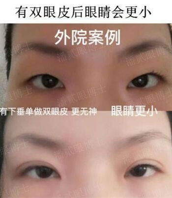 在原有双眼皮的基础上割双眼皮,割双眼皮不知道开扇形还是平行形