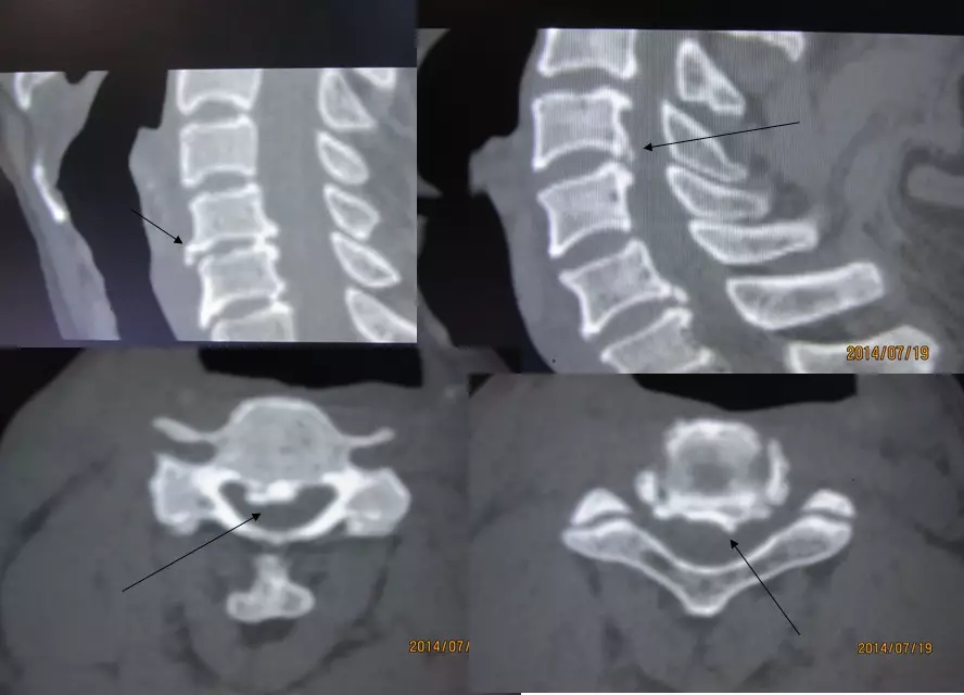 颈椎腰椎疾病ct及mri诊断,腰椎ct可以发现肠部病变吗
