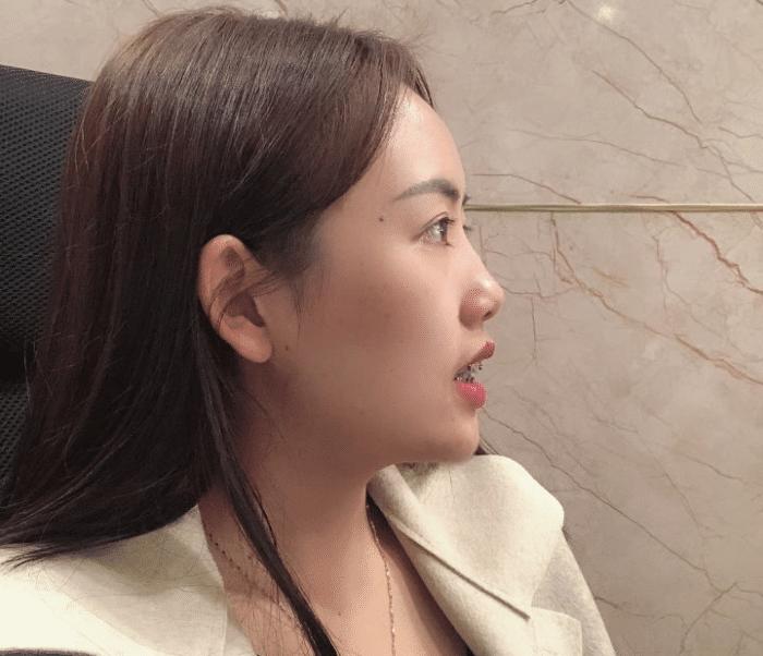 牙套隐形日记,牙套日记正颌