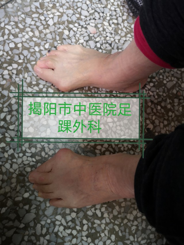 关注足部的健康,关注足部健康