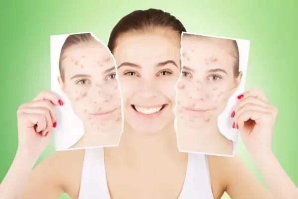 痘印怎么去除视频教程,痘印怎么去除黑色素沉淀