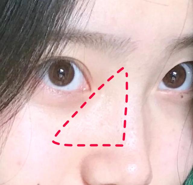 眼睛下面毛周角化症怎么治,眼睛下方毛周角化可以治疗吗