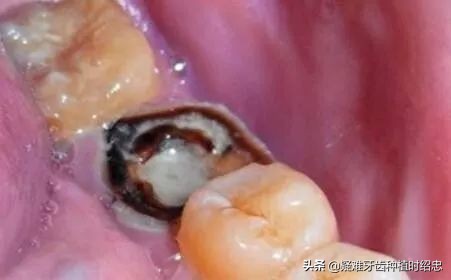 成都牙髓炎根管治疗的医院,牙髓炎必须根管治疗吗视频教程