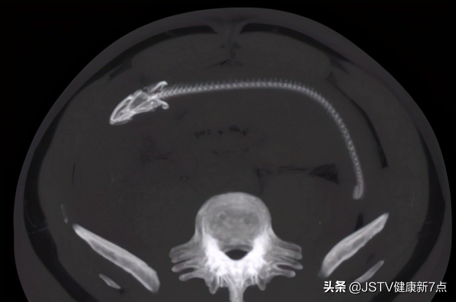 突发！长约40公分黄鳝从男子肛门钻进肚子