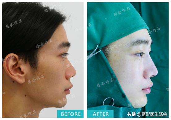 假体材料都有哪几种,假体材料都有什么