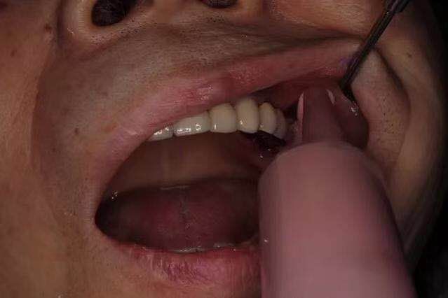 咬合重建的程序,咬合重建做嵌体