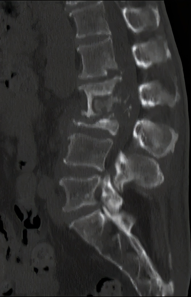 腰椎结核会引起哪些症状,久坐腰疼是腰椎结核么