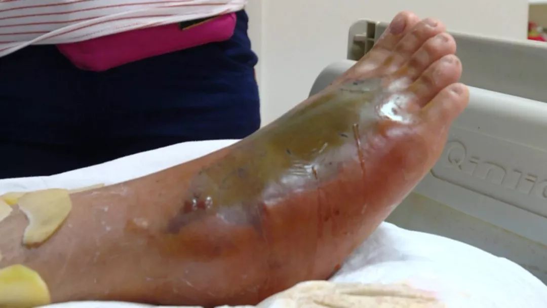 被竹叶青毒蛇咬了严重吗,小孩被竹叶青蛇咬伤