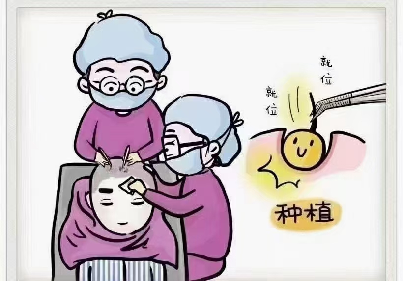大家谈谈植发的经历,植发真的是一个漫长的过程
