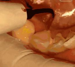 自己抠下来一块牙结石,自己动手抠牙结石