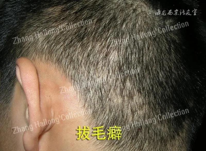 拔毛癖是因为压力吗,拔毛癖是心理问题吗