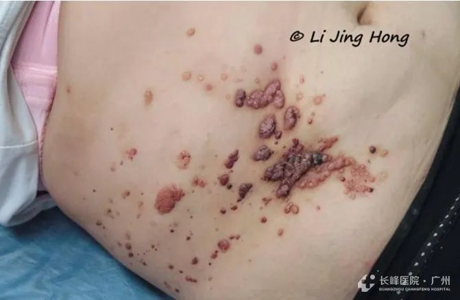 腹部淋巴管畸形介入治疗多久恢复,淋巴管畸形和静脉畸形有什么区别