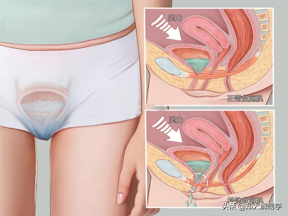女性盆底功能障碍性疾病表现,南通治疗盆底功能障碍的医院