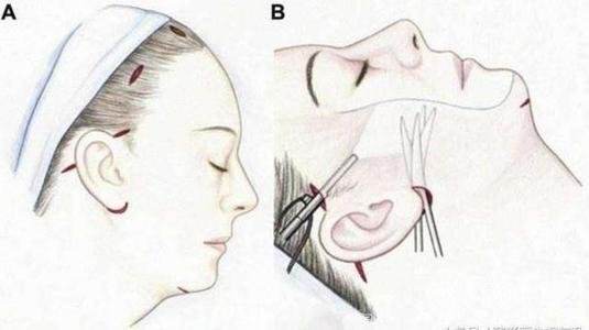 拉皮除皱手术真的有效吗,拉皮除皱手术真的有效果吗