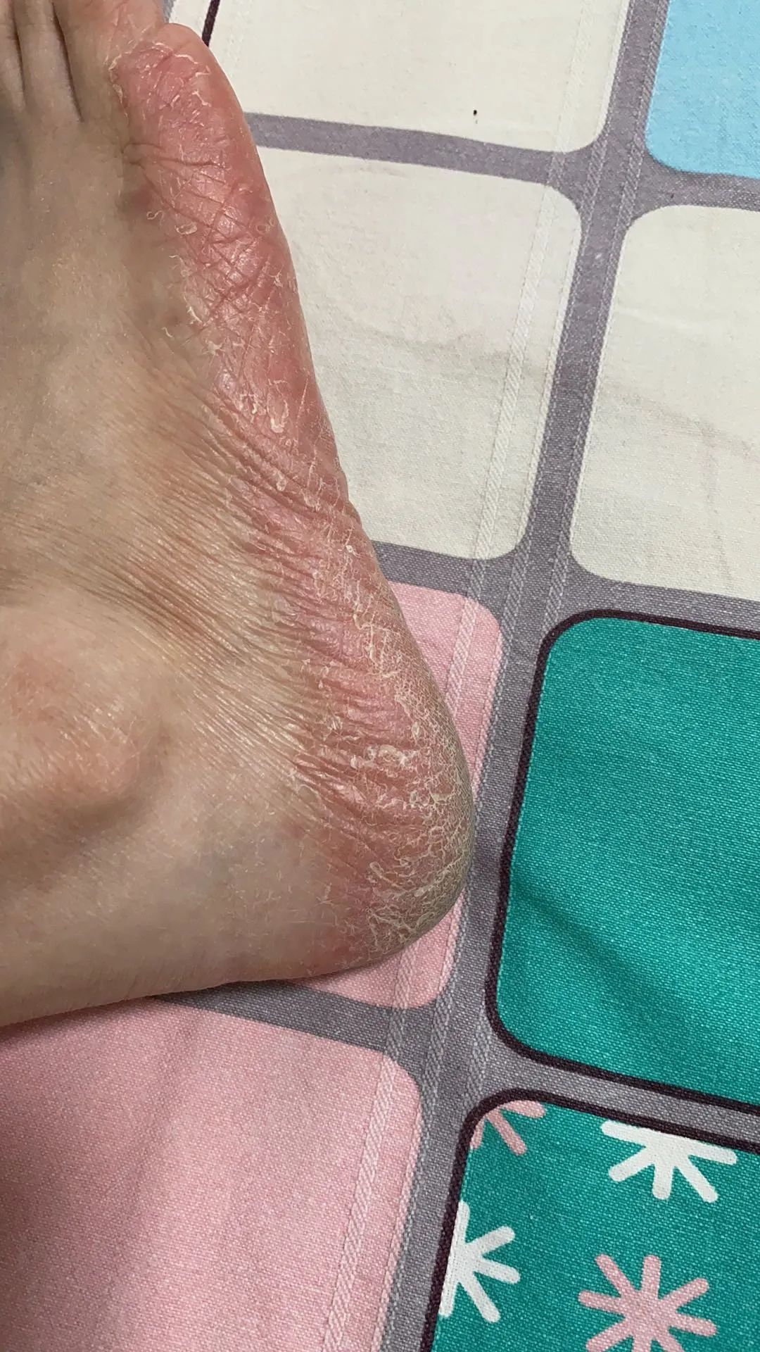 家里治脚气最好的方法,家庭治脚气的最好方法