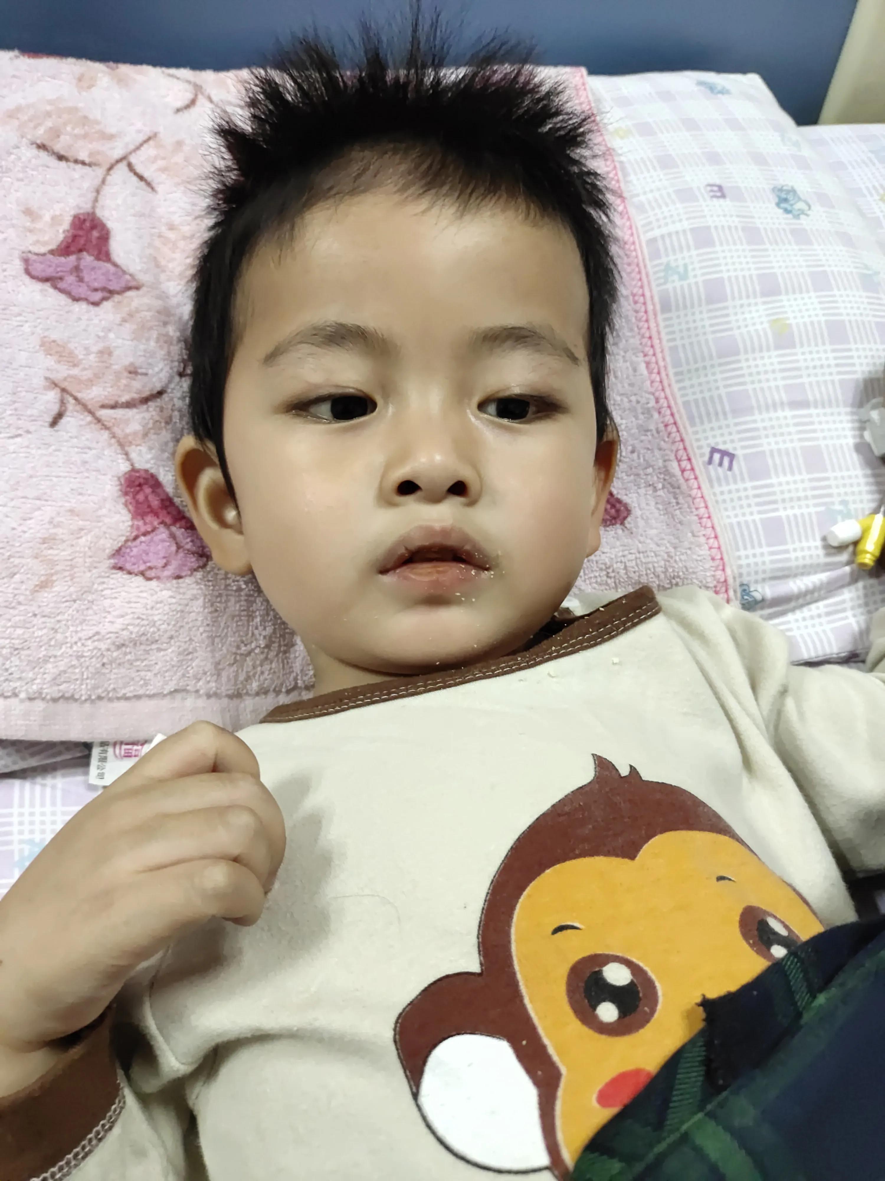 小儿化脓性脑膜炎会有后遗症吗,宝宝化脓性脑膜炎