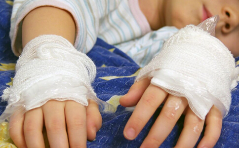 孩子严重烫伤9天才被家长送医,儿童烫伤最佳处理时间只有两分钟