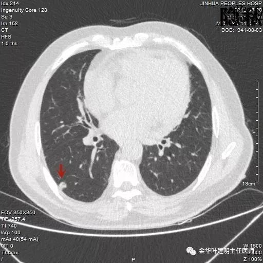 警惕-会是简单的肺大泡吗？