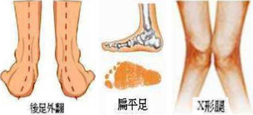 孩子足外翻该怎么办,孩子足外翻是怎么回事