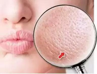 毛孔粗大怎么改善和调理,毛孔粗大到底怎么办学生