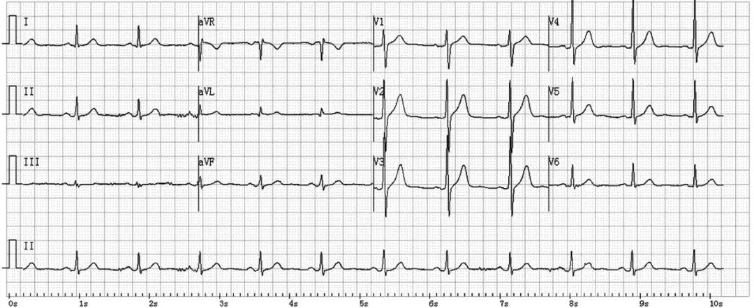 心肌梗死两年心电图正常怎么回事,心电图检查心肌梗死心肌酶正常