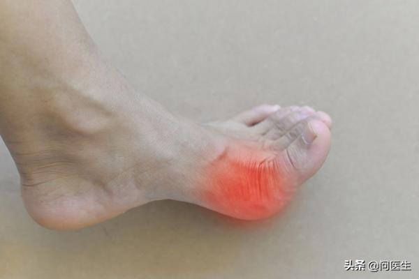 脚趾痛风发作时持续发热,痛风老是右脚发作