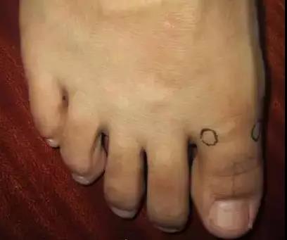 一病一绝招,治疗一病一穴奇效法