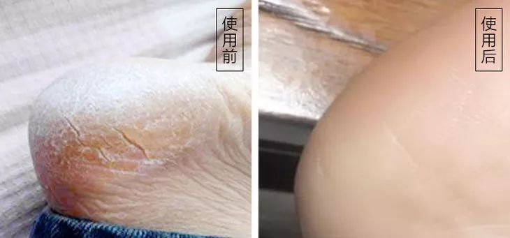 手脚皮肤干裂怎样快速保湿,缓解手脚干裂的小妙招