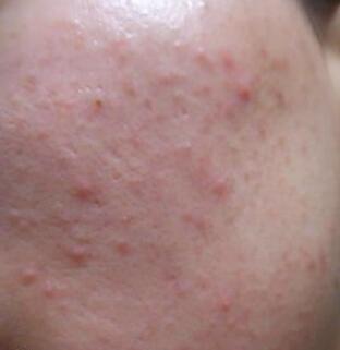 30多岁了脸上还是长痘痘反反复复,脸上反反复复长痘痘是怎么回事