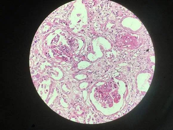 肾脏病肌酐高吃什么能降肌酐,慢性肾衰竭肌酐怎么降下来