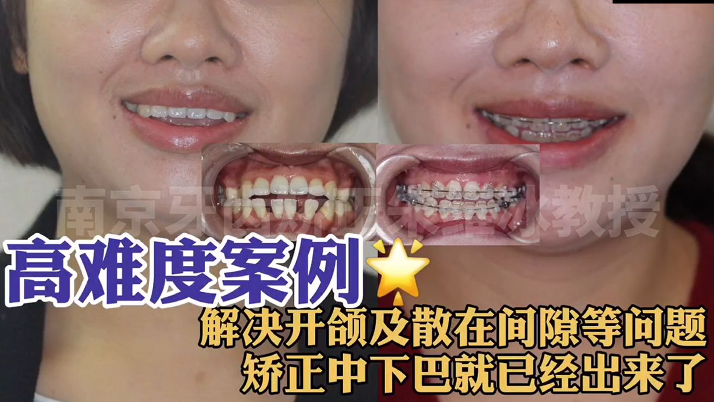 牙齿矫正骨开窗,骨壁比较薄牙齿矫正会骨开窗吗