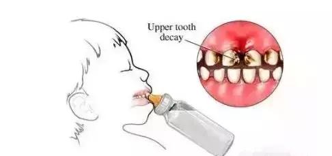长期使用奶瓶引起的嘴唇外翻图片,奶瓶用久了会龅牙吗