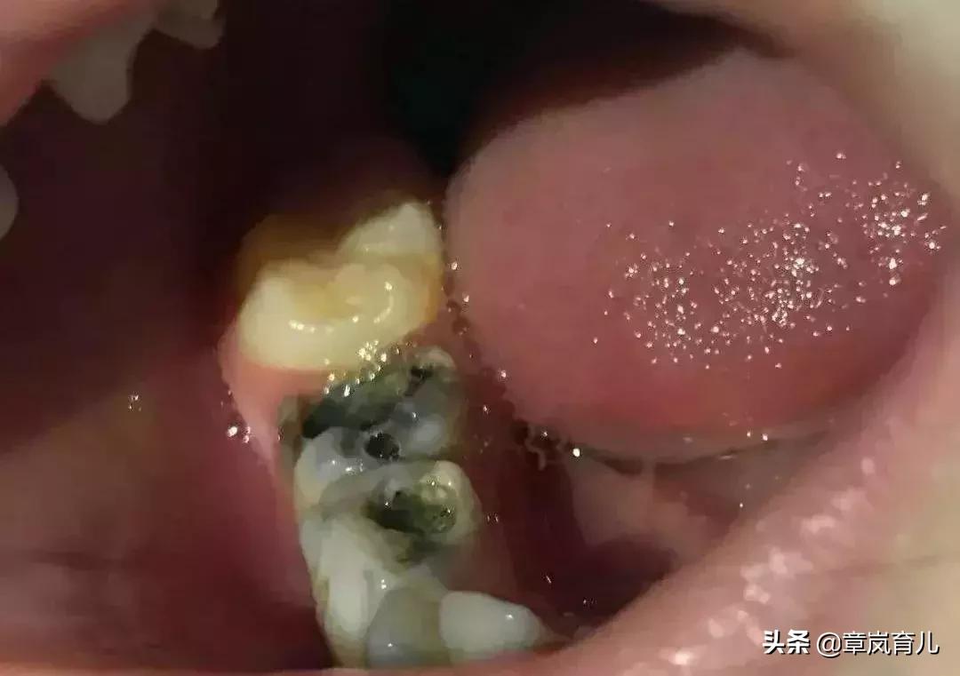 一排牙全拔了可以种牙嘛,牙齿拔光了多久可以种牙