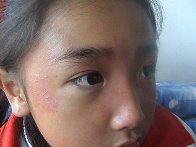 婴儿有胎记如何确认是红瘤,宝宝生下来的胎记