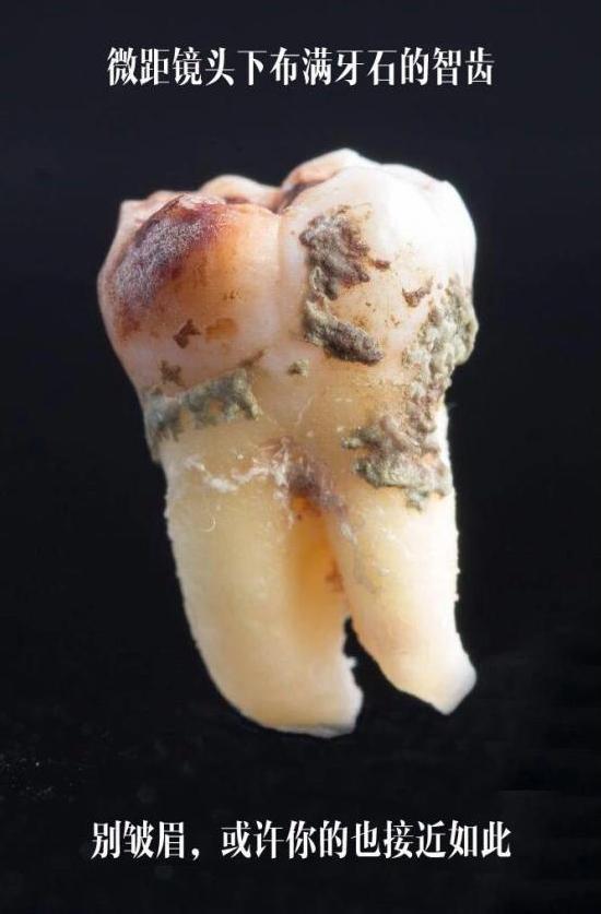 放大两千倍的牙齿表面长什么样？不愧是人体最脏的地方，不堪入目