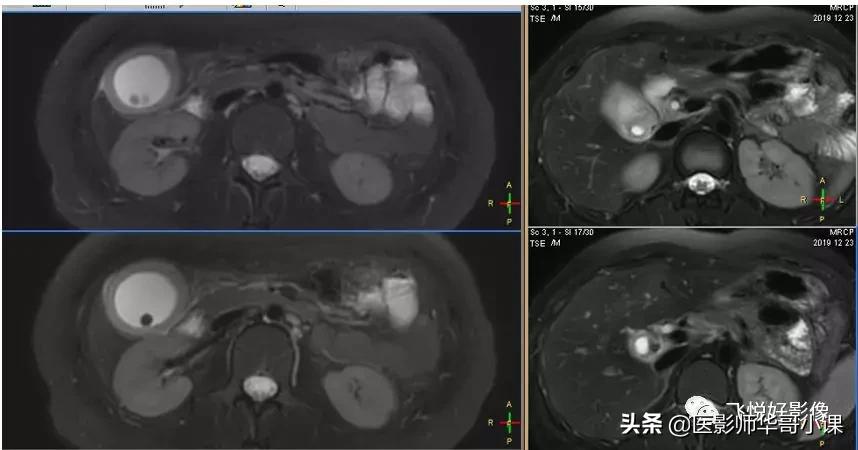 「飞利浦磁共振技术」胆道系统胆胰管水成像之3D_MRCP_BH