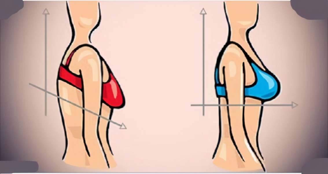 产后胸部干瘪下垂怎么恢复挺拔,产后胸部严重下垂可以做什么修复