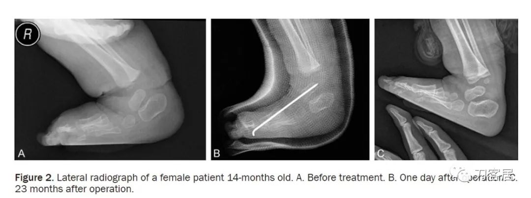 一个脊柱外科医生与马蹄内翻足的纠缠-写在6.3国际马蹄内翻足日前