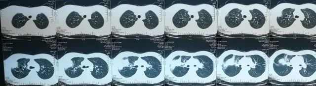 如何在CAP初始治疗后72h内进行病情评价？其成功关键有哪些？