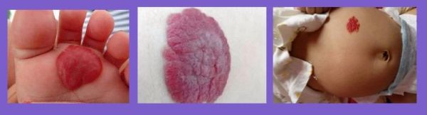 新生儿脸上身上长红斑怎么回事,身上脸上出红斑疙瘩吃什么药