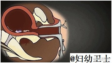 人流对生育影响有多大,人流不干净二次清宫影响怀孕吗