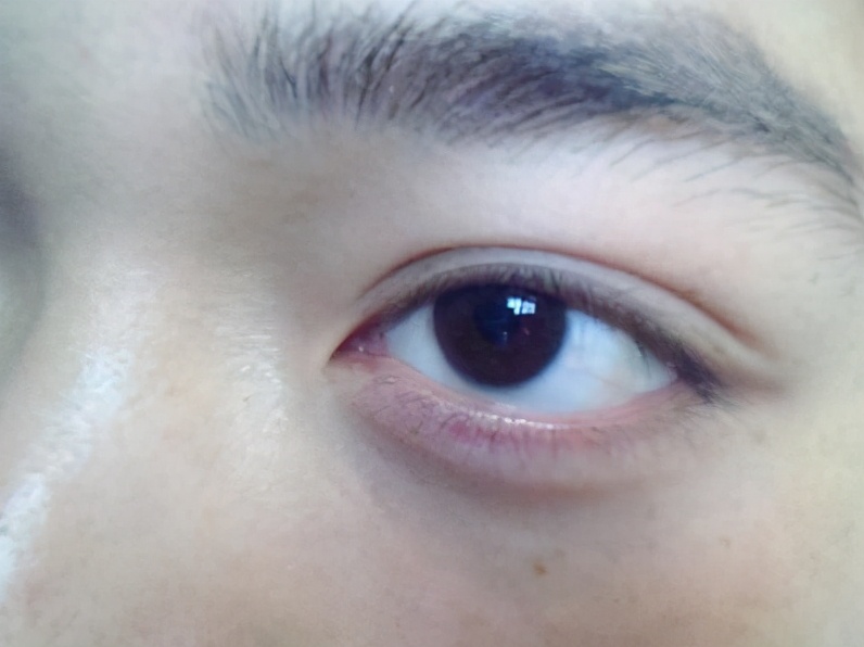 肌营养不良累及心脏,进行性肌营养不良基因48到51缺失