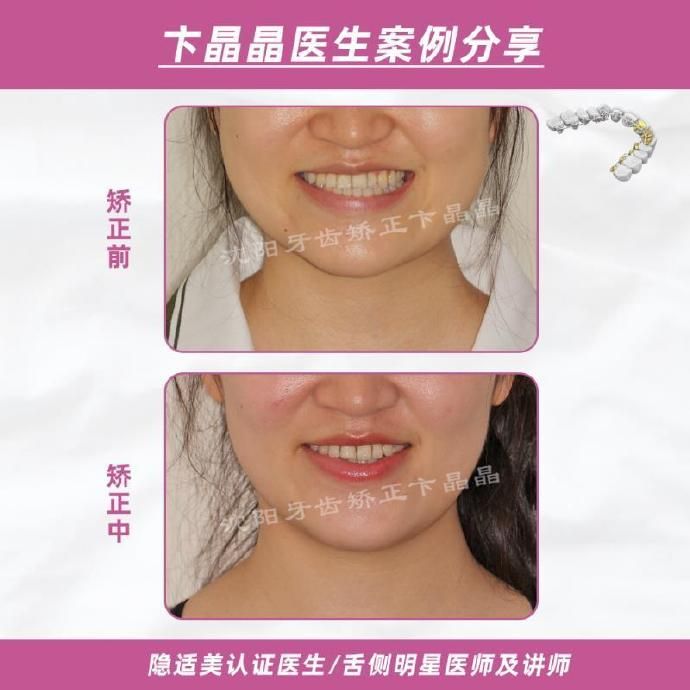 隐适美牙套矫正过程,隐适美个别牙反颌矫正真实案例