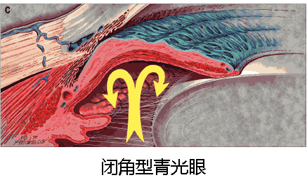 青光眼预防,认识青光眼