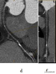 cta和血管造影怎么选择,血管oct检查与血管造影检查的区别